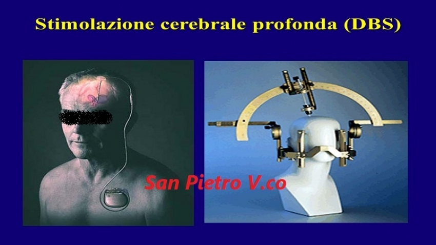 Intervento innovativo di stimolazione cerebrale: la testimonianza di un sanpietrano